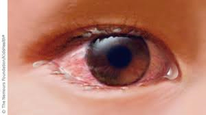 Información sobre la conjuntivitis alérgica